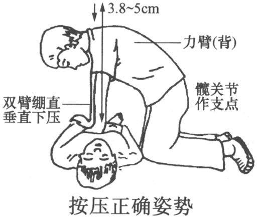 心肺復(fù)蘇模擬人操作常見(jiàn)錯(cuò)誤心肺復(fù)蘇模型易犯錯(cuò)誤